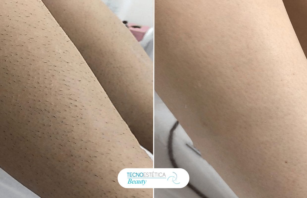 Antes y después depilación láser ingles en Barcelona