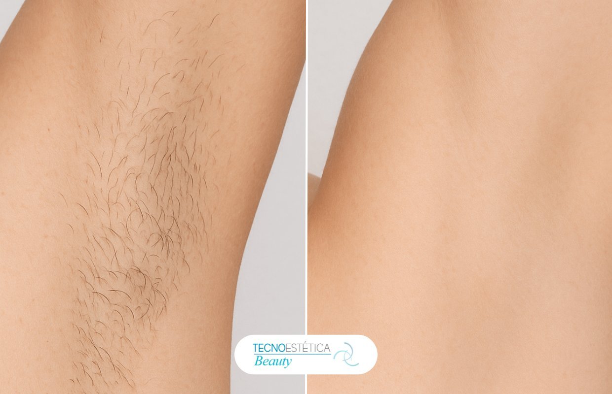 Antes y después depilación láser axilas en Barcelona