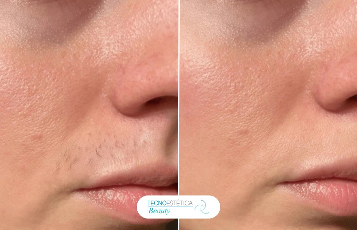 Antes y después depilación láser facial labio superior en Barcelona