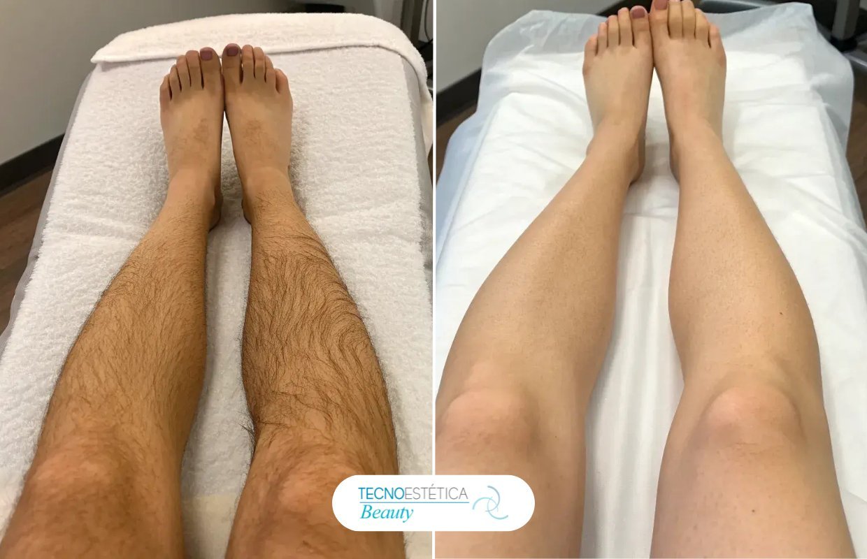 Antes y después depilación láser piernas completas en Barcelona