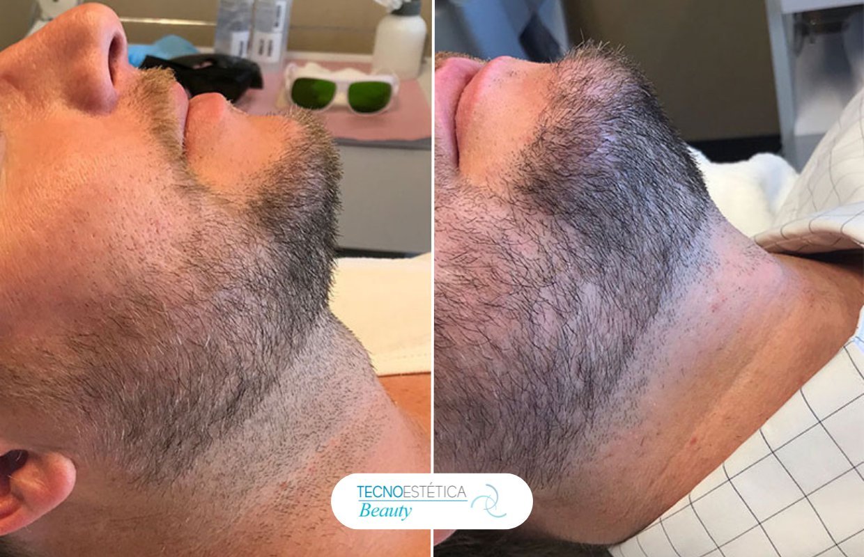 Antes y después depilación láser barba hombre en Barcelona